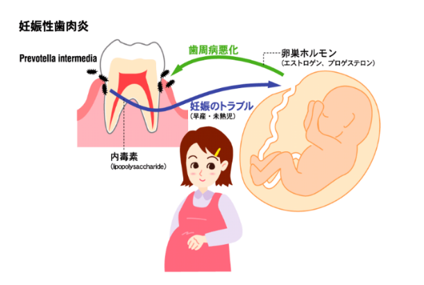 妊娠中の口腔トラブル