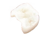 インプラント