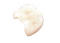 インプラント